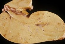 醫生：每天吃對這3種食物，脂肪肝才會「不藥而愈」！-頭條楓林網