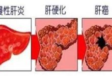 台灣曾被國際稱作是「肝病之國」，醫生警告：「這3種食物再碰，肝癌很快就會來！」-頭條楓林網