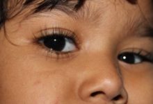 做眼保健操能預防近視嗎-頭條楓林網