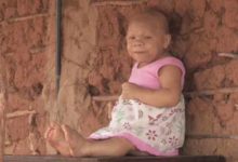 巴西女9個月大即停止成長「37歲仍是不老寶寶」，繼母不嫌棄悉心照顧，如今終於等到「治療希望」！-頭條楓林網