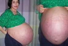 印度女子子宮外孕卻「逃避動手術」，結果「胎兒骸骨在腹部藏了38年」才被取出！-頭條楓林網