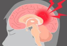 醫生提到：吃「這2種食物 」可以擋住「腦中風」！ 可惜你一個​​都不喜歡吃...-頭條楓林網