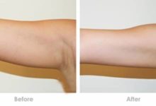 100%擺脫蝴蝶袖，七天見效，六個瘦手臂操…-頭條楓林網