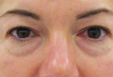 「眼袋」超嚴重好困擾！？只要跟著「這樣做」，不動刀也能跟眼袋說掰掰了！-頭條楓林網