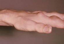 醫生：這種湯和這種肉最招痛風，家家戶戶每天都吃-頭條楓林網