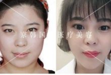 在韓國第一次做自體脂肪填充過程恢復經歷感受-頭條楓林網