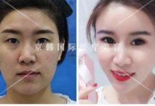 在北京脂肪填充怎麼避免硬塊囊腫結節等風險呢-頭條楓林網