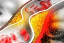 這6種人易得高血脂，注意預防！-頭條楓林網