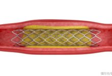 心臟支架是選擇進口還是國產，聽聽心內科醫生怎麼說！-頭條楓林網