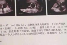 孕婦早產如何預防? 醫生: 了解清楚原因是關鍵-頭條楓林網