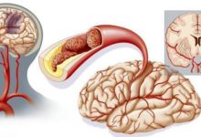 8種人容易得血栓！-頭條楓林網