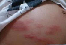 孕期孕婦身體「癢」？這種情況出現就得住院治療-頭條楓林網