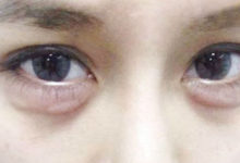 女人到了25歲眼部肌膚鬆弛容易「有眼袋」？！教你1招去除眼袋的小妙招，超有效又省錢！-頭條楓林網