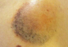 身上總有一堆大大小小的瘀血？教你5個正確方法快速治癒「瘀青」，穿短褲短裙也不害怕啦！-頭條楓林網