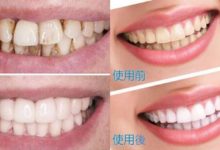 無論男女，一口黃牙有救了！  2分鐘就把多年累積的黃牙垢都去除了！ 牙齒變得又白又乾淨！-頭條楓林網