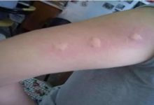 被蚊子咬後皮膚越抓越癢，教你個止癢絕招，只需10秒鐘止癢不留印痕-頭條楓林網