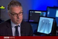 憂鬱症看心理醫生沒效？　學者提出震撼理論　「它不是精神病，是大腦發炎」-頭條楓林網