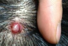 頭皮上長痘痘和膿包痛又癢怎麼辦 快學正確抗痘方法避免引發禿頭危機-頭條楓林網