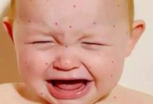 寶寶濕疹、痱子傻傻分不清楚？兒科醫生教你輕鬆區別！-頭條楓林網