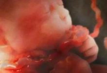 懷孕六個月，因為臍帶繞頸胎兒引產？-頭條楓林網