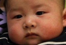 嬰兒長濕疹不可怕，它是濕疹的死對頭，抹一抹，將濕疹連根都拔掉-頭條楓林網