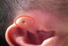 媽媽擠了擠寶寶耳邊小孔，奶奶破口大罵！結果發生了這樣的事-頭條楓林網