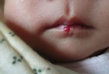 寶寶的血管瘤是什麼類型？血管瘤應該如何治療？-頭條楓林網