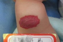 嬰幼兒血管瘤治療用哪種方法？血管瘤治療前這些要了解-頭條楓林網