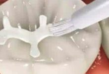 什麼是窩溝封閉？何時做窩溝封閉最合適？-頭條楓林網