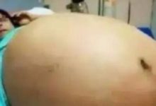 廣西39歲孕婦懷六胞胎，看到孩子的性別，整個醫院炸開了鍋-頭條楓林網